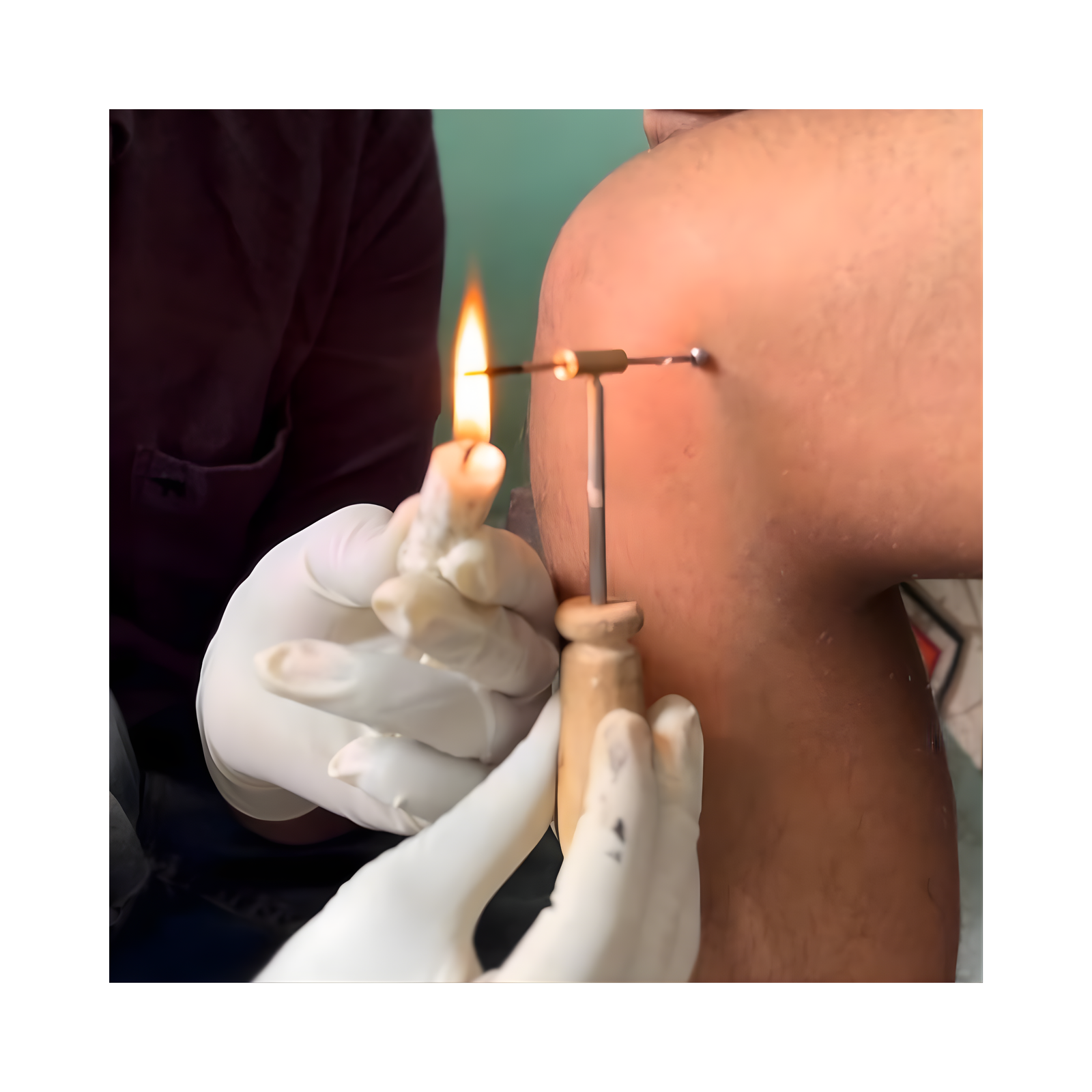 Agni karma thermal healing therapy